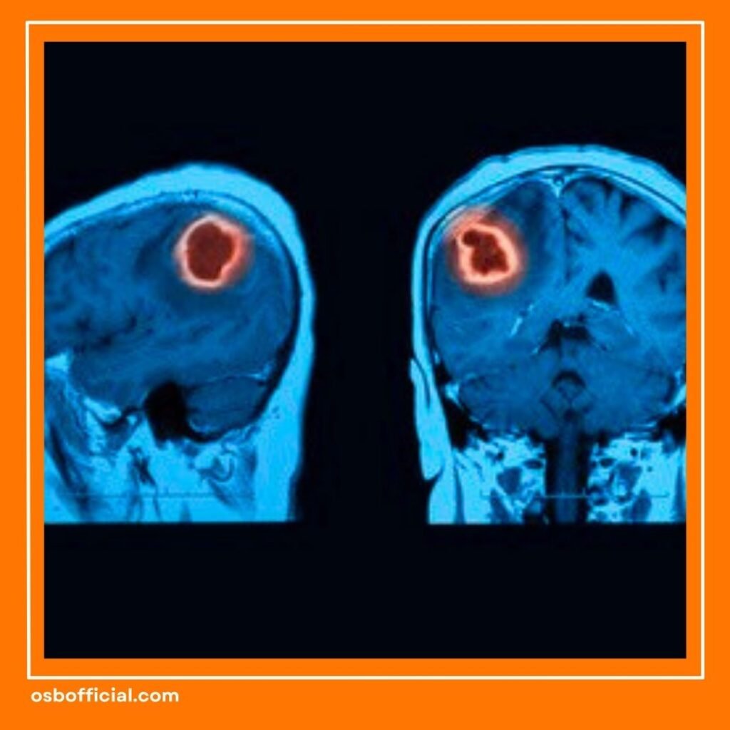 Radang Otak dan Abses Otak