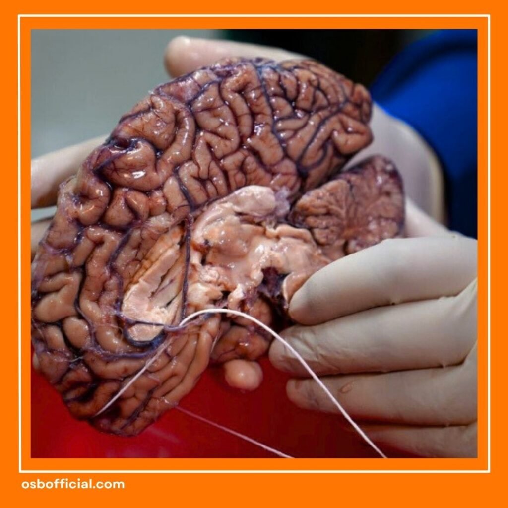 Tanda Awal Kanker Otak