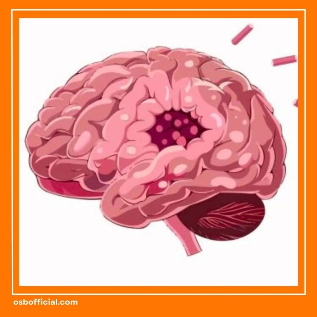 Tanda Awal Tumor Otak