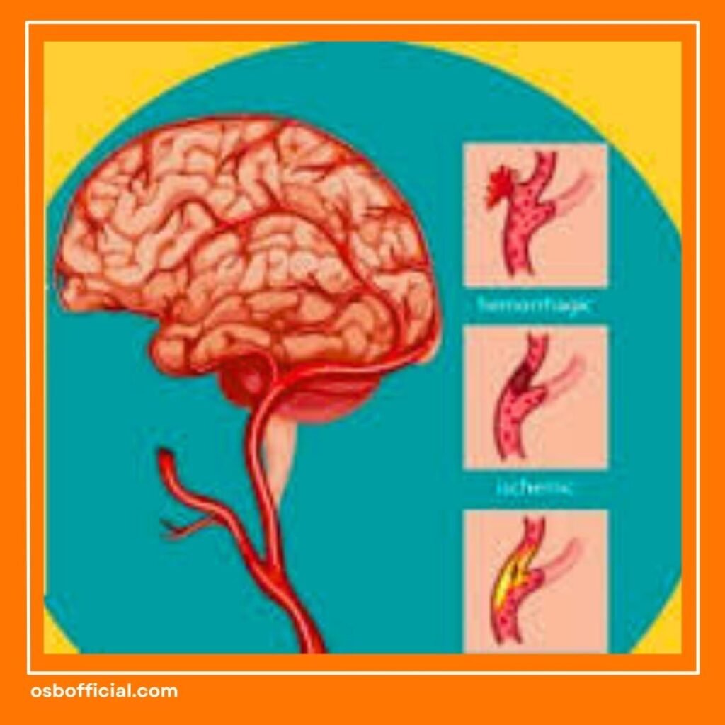 Ciri Ciri Penyumbatan Saraf Otak