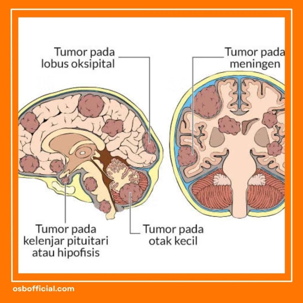 Apakah Tumor Otak Bisa Sembuh
