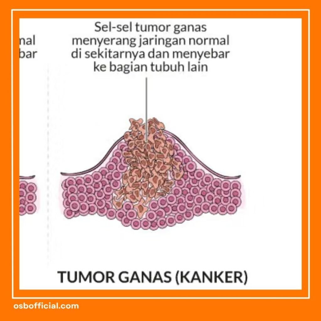 Apakah Tumor Otak Bisa Sembuh