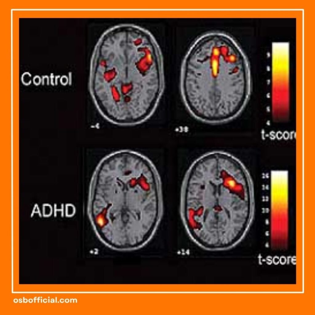 Otak ADHD