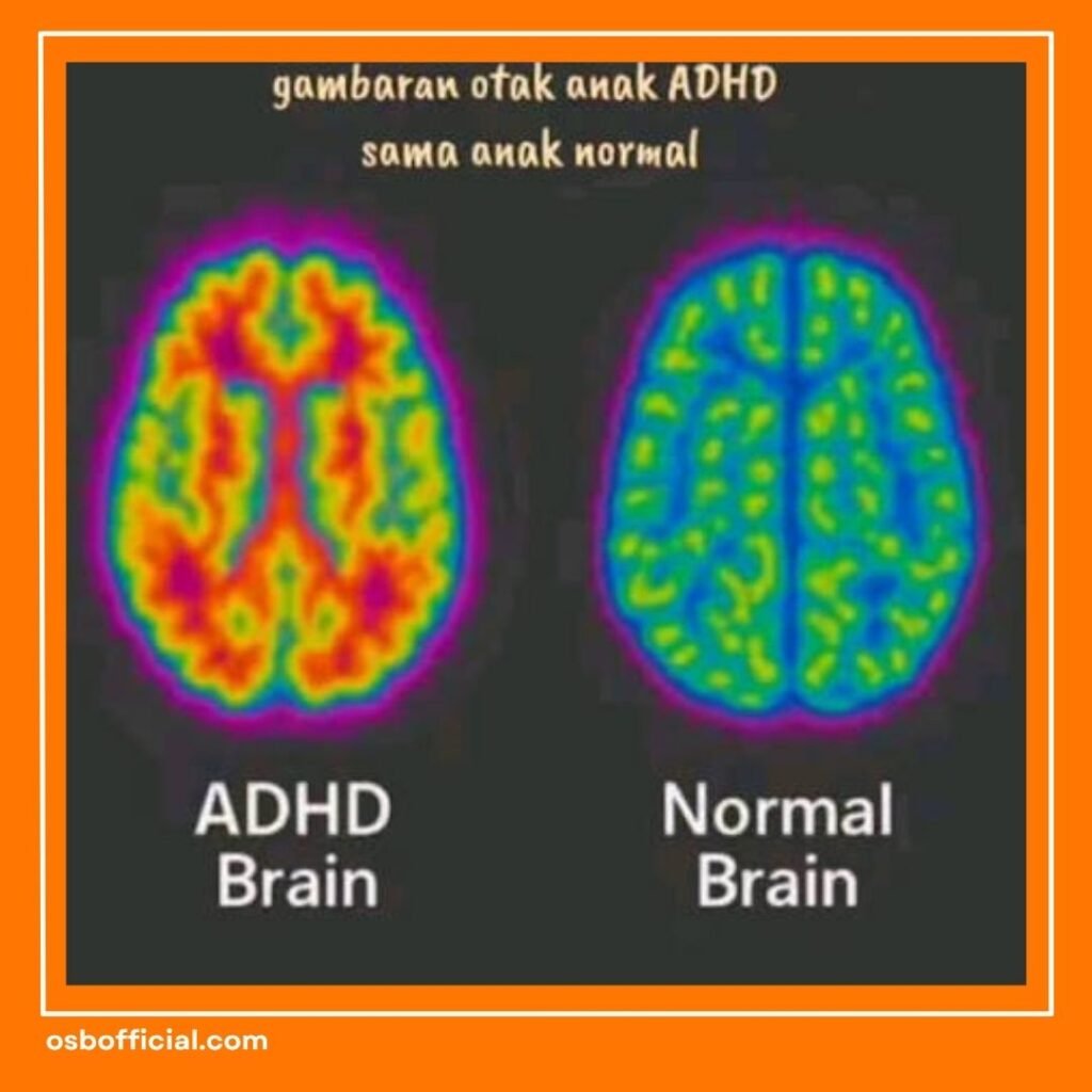 Otak ADHD